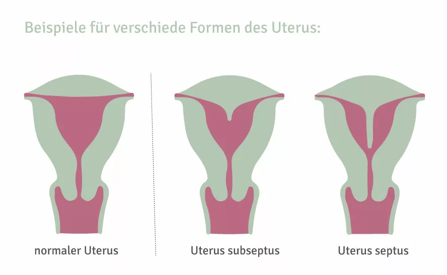 Formen des Uterus